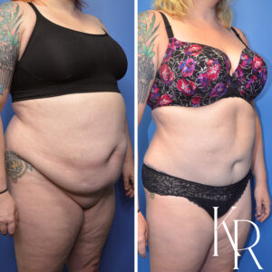 Before and after abdominoplasty