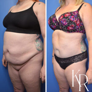 Before and after abdominoplasty
