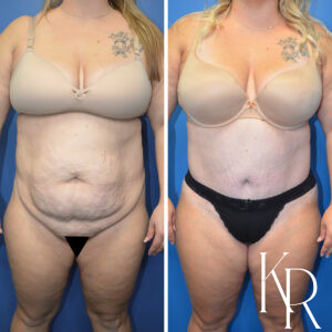 Before and after abdominoplasty