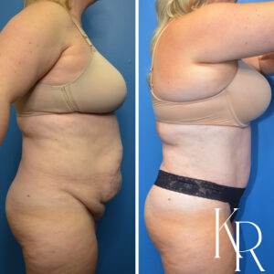 Before and after abdominoplasty