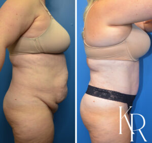 Before and after abdominoplasty