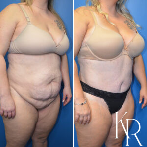 Before and after abdominoplasty