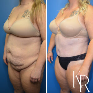 Before and after abdominoplasty