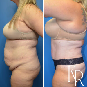 Before and after abdominoplasty