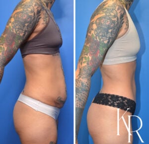 Before and after abdominoplasty