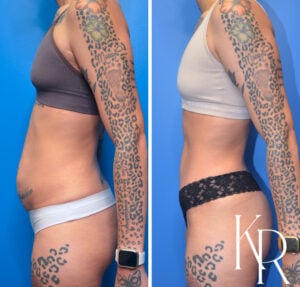 Before and after abdominoplasty