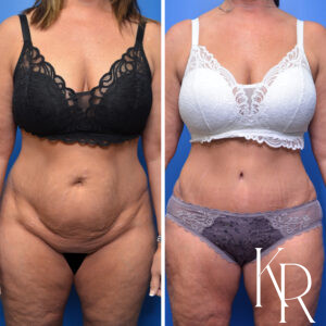 Before and after abdominoplasty