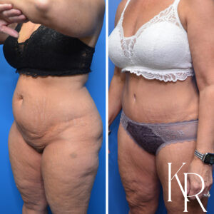 Before and after abdominoplasty