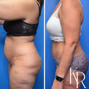 Before and after abdominoplasty