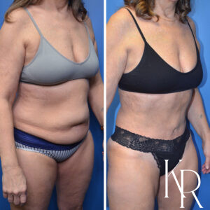 Before and after abdominoplasty