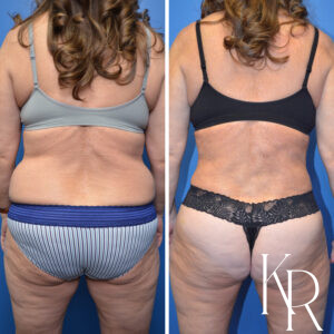 Before and after abdominoplasty