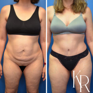 Before and after abdominoplasty