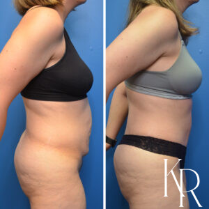 Before and after abdominoplasty