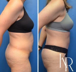 Before and after abdominoplasty