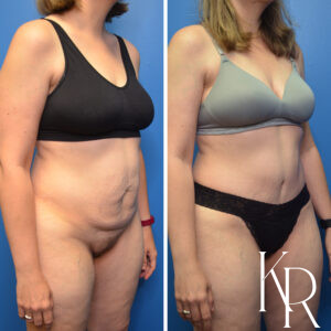Before and after abdominoplasty
