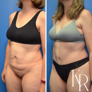 Before and after abdominoplasty