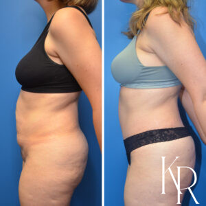 Before and after abdominoplasty