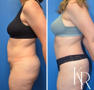 Before and after abdominoplasty