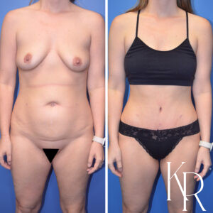 Before and after abdominoplasty