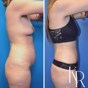 Before and after abdominoplasty