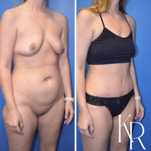Before and after abdominoplasty