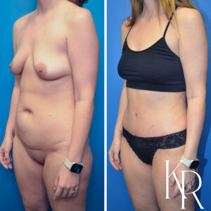 Before and after abdominoplasty