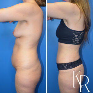 Before and after abdominoplasty