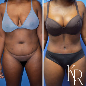 Before and after abdominoplasty