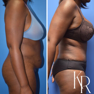 Before and after abdominoplasty