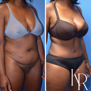 Before and after abdominoplasty