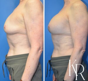 Before and after breast augmentation
