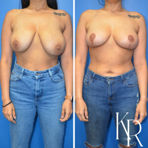 Before and after breast reduction