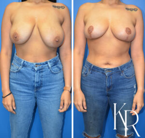 Before and after breast reduction