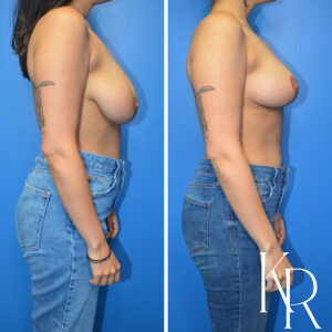 Before and after breast reduction