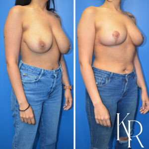 Before and after breast reduction
