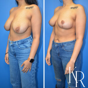 Before and after breast reduction