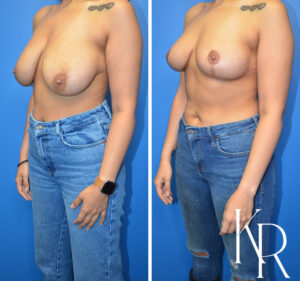 Before and after breast reduction