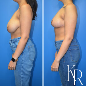 Before and after breast reduction