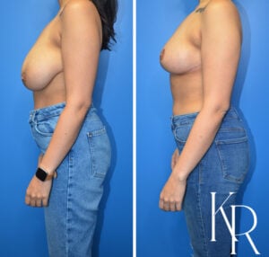 Before and after breast reduction