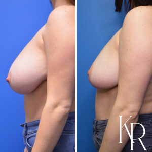 Before and after breast reduction
