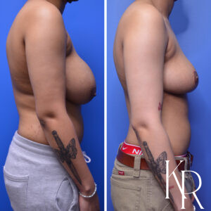 Before and after breast reduction