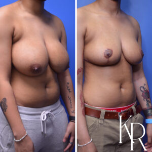 Before and after breast reduction
