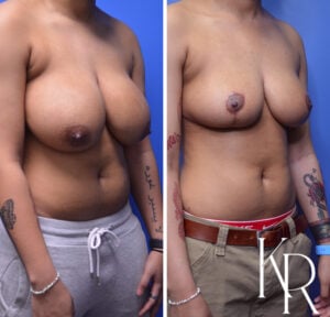 Before and after breast reduction