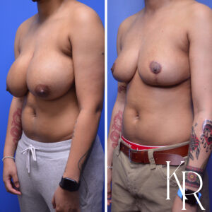 Before and after breast reduction