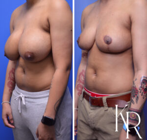 Before and after breast reduction