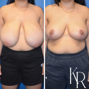 Before and after breast reduction