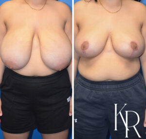Before and after breast reduction
