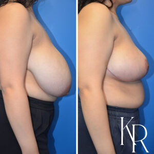 Before and after breast reduction