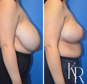 Before and after breast reduction