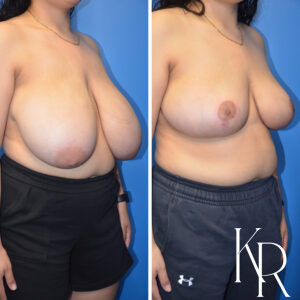 Before and after breast reduction